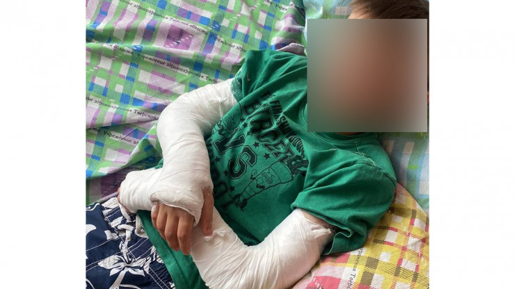 В Тверской области в детском лагере ребёнок сломал обе руки - новости ТИА