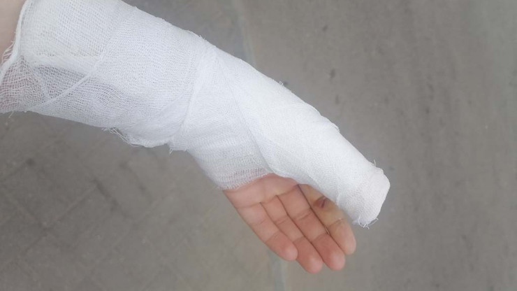 Алабай прокусил руку и сломал палец жительнице Твери - новости ТИА