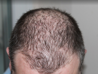 Учёные назвали выпадение волос последствием коронавируса - новости ТИА