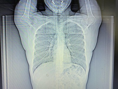 Рентген не показывает ковидную пневмонию - Новости ТИА
