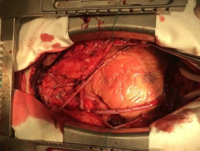 В тверской ОКБ в 2021 году сделали 19 операций по протезированию клапанов сердца - новости ТИА
