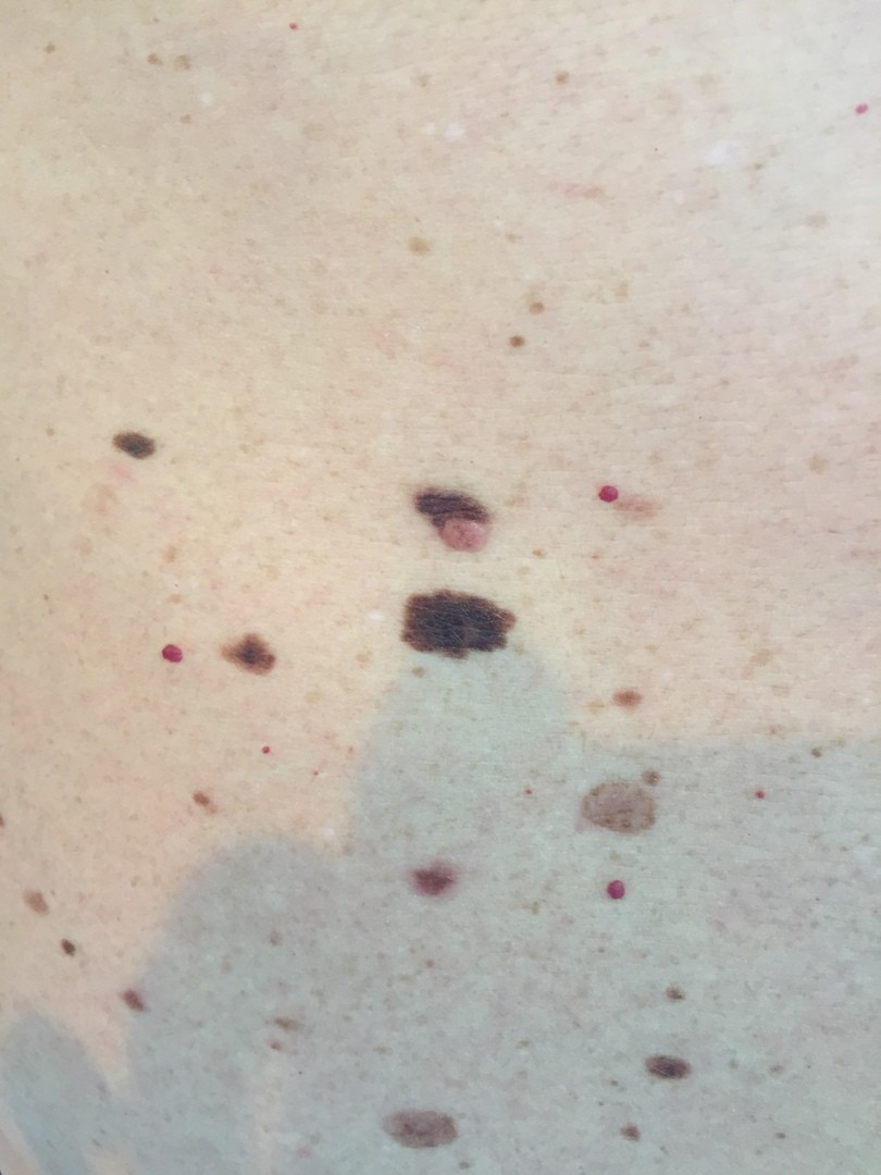 Рак кожи после солнечного ожога фото
