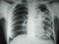 Год спустя: к чему привели фальшивые справки из Бежецкой ЦРБ для умершей от туберкулёза школьной медсестры - Новости ТИА