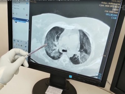 Спасенная пациентка со 100% поражением лёгких поблагодарила врачей - новости ТИА