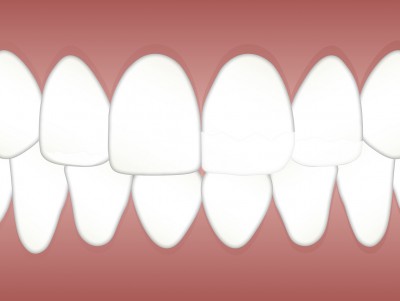 Семь мифов об отбеливании зубов на дому - новости ТИА