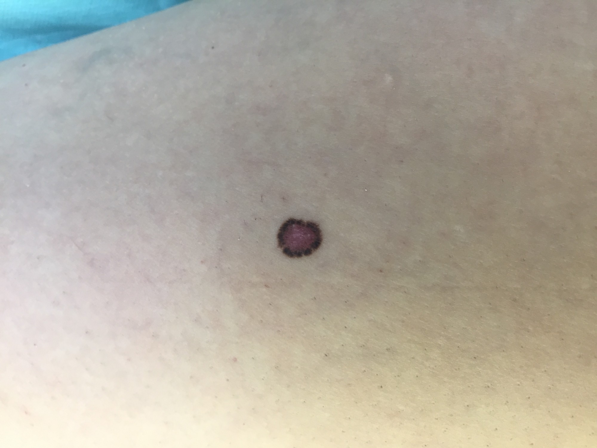 Рак кожи после солнечного ожога фото
