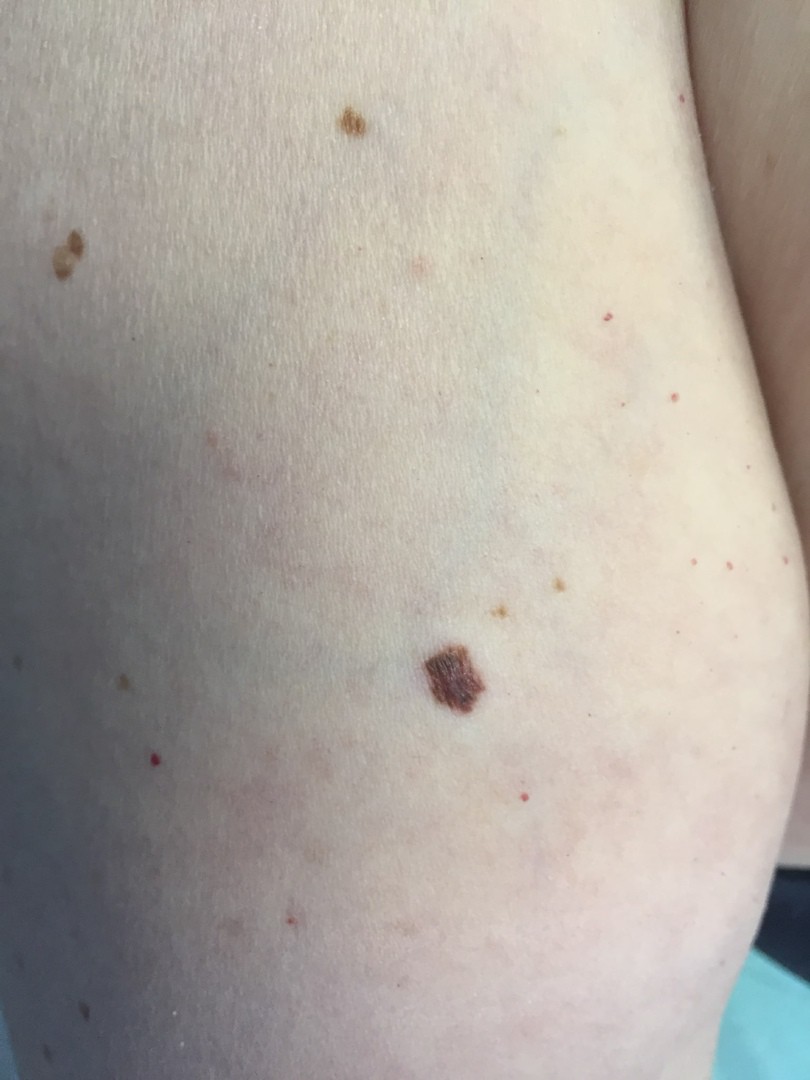 Рак кожи после солнечного ожога фото thumbnail